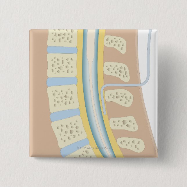 Chapa Cuadrada Anestesia epidural (Anverso)