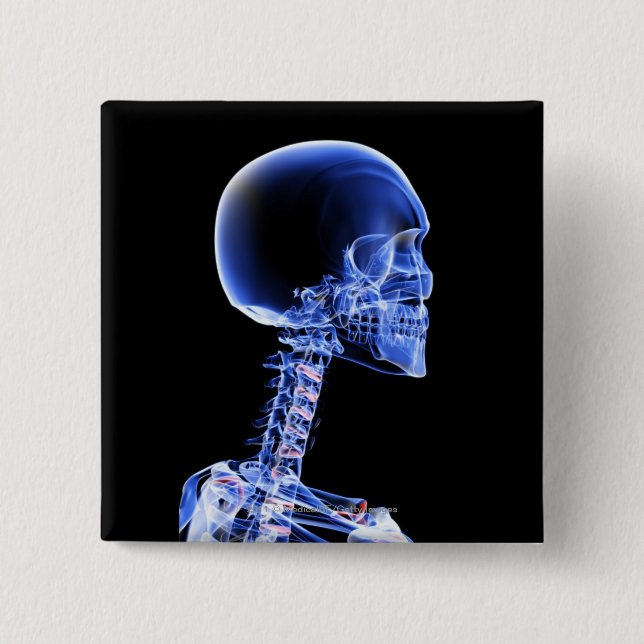 Chapa Cuadrada Ciérrese encima de la radiografía de los huesos en (Anverso)