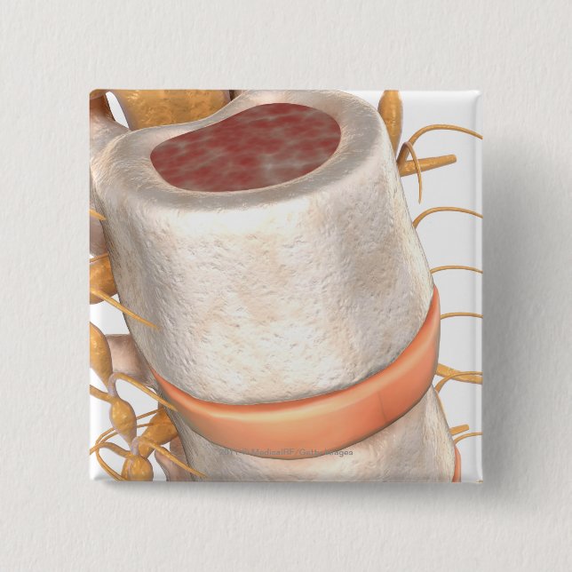 Chapa Cuadrada Ciérrese para arriba de un disco invertebral en la (Anverso)