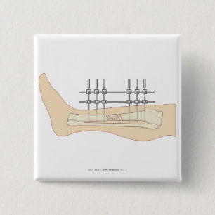 Chapa Cuadrada Fixator externo