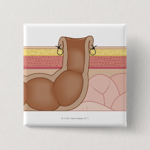 Chapa Cuadrada Operación del intestino grueso permanente