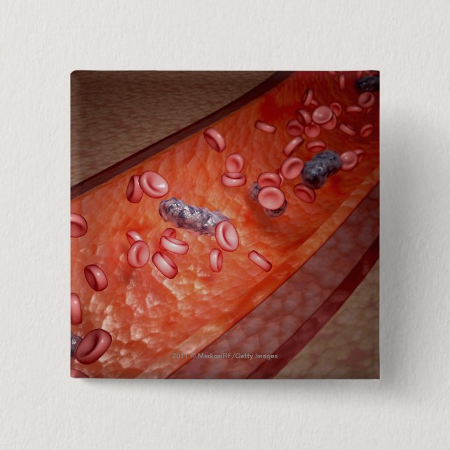 Chapa Cuadrada Representación microscópica de una infección de la (Anverso)