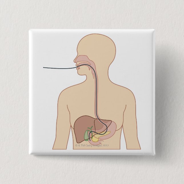 Chapa Cuadrada Ruta del endoscopio (Anverso)