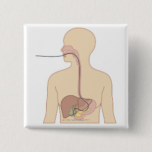 Chapa Cuadrada Ruta del endoscopio