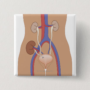 Chapa Cuadrada Trasplante del riñón