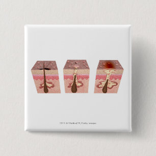 Chapa Cuadrada Vista de qué causa acné