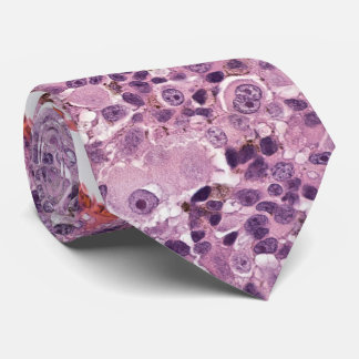 Corbata Melanoma uvesical epitelioide