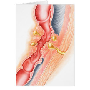 Desarrollo De La Fistula