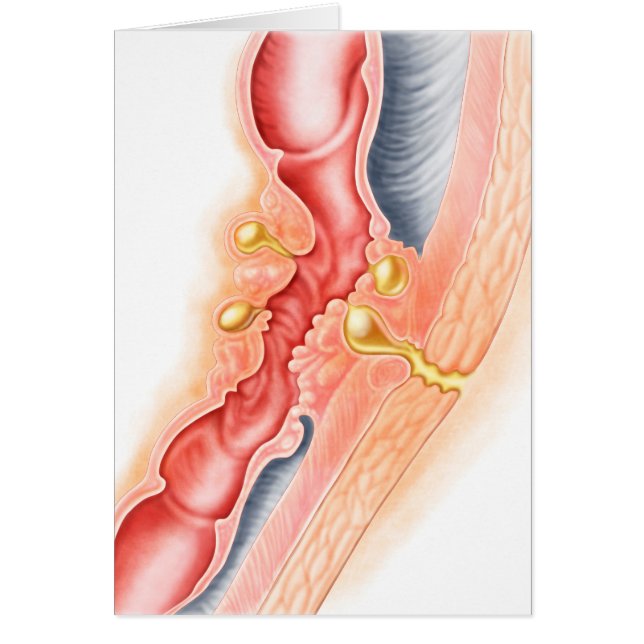 Desarrollo De La Fistula (Frente)