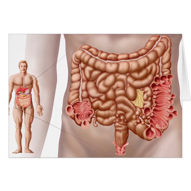 Diverticulitis En La Región Colónica Descendente (Anverso (Horizontal))