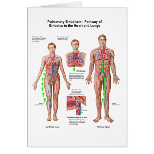 Embolia pulmonar, camino del émbolo