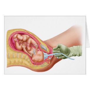 Entrega De Feto Utilizando Extracción De Vacío