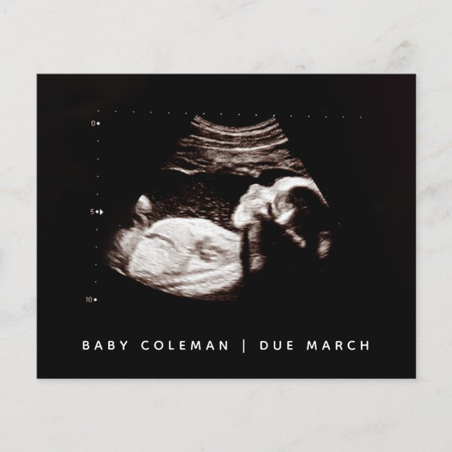 Flyer Sonograma de ultrasonido de bebé de embarazo presu (Frente)