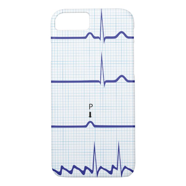 Funda De Case-Mate Para iPhone Caso del iPhone de ECG/EKG (Reverso)