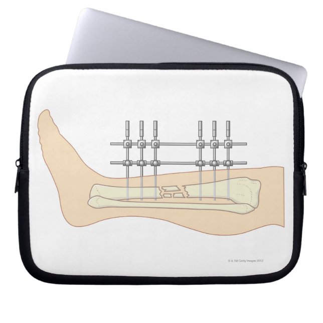 Funda Para Portátil Fijador externo (Frente)