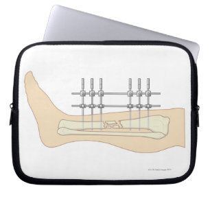 Funda Para Portátil Fixator externo