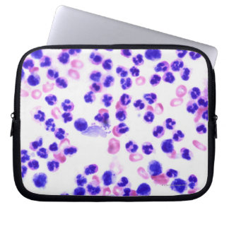 Funda Para Portátil Infección por Staph