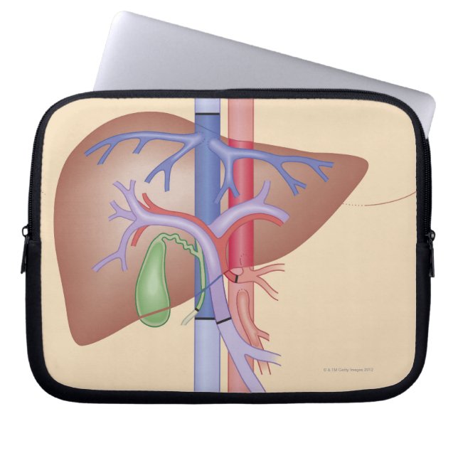 Funda Para Portátil Procedimiento de trasplante hepático (Frente)