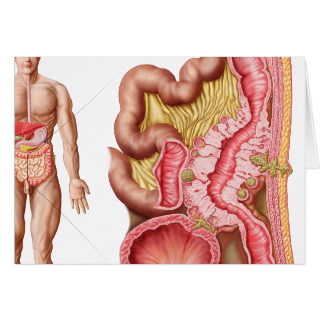 Ilustracion De Diverticulosis En El Colón (Anverso (Horizontal))