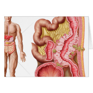 Ilustracion de la diverticulosis en los dos puntos