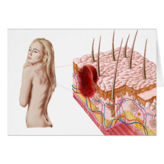 Ilustracion De Un Crecimiento Atípico En La Piel