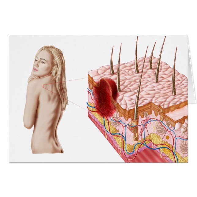 Ilustracion De Un Crecimiento Atípico En La Piel (Anverso (Horizontal))
