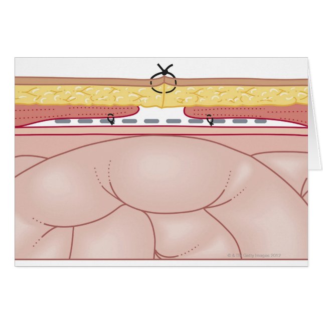 Ilustracion de una Hernia (Anverso (Horizontal))