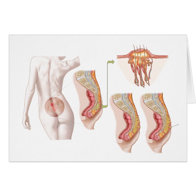 Ilustración Médica De Un Ciclo Pilonidal (Anverso (Horizontal))