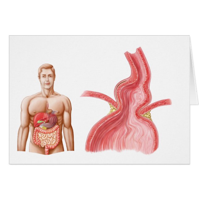 Ilustración Médica De Una Hernia Hiatal En El (Anverso (Horizontal))