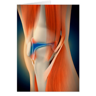 Ilustracion Médico: Inflamación En Knee