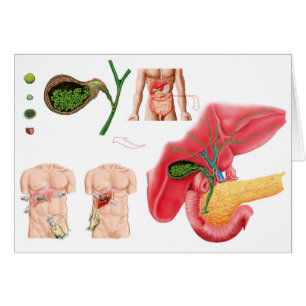 Ilustracion que representa la colecistectomía