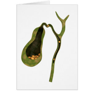 Imagen Conceptual De Gallstones Inside Gall