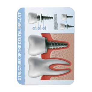 Imán Estructura del implante dental