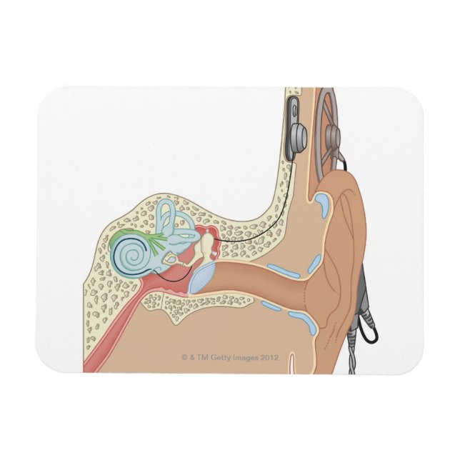 Imán Implantes cocleares (Horizontal)