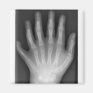 Imán ¡Polydactyly, seis manos digitadas, radiografía,
