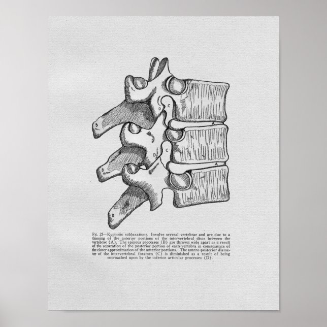 Impresión de cosecha de subluxación quiropráctica (Frente)