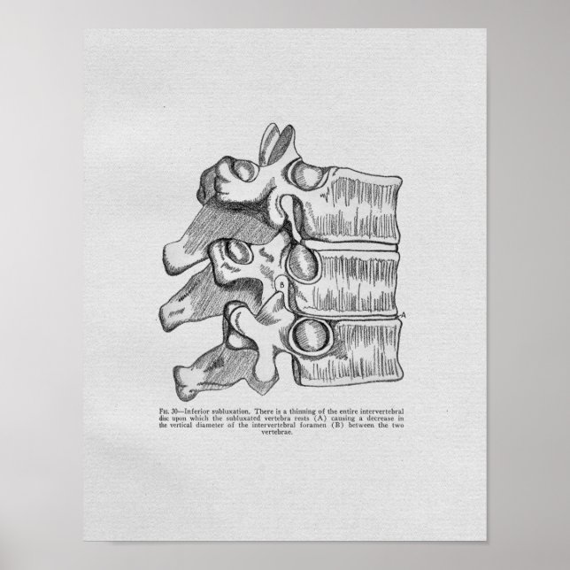 Impresión vintage de subluxación vertebral quiropr (Frente)