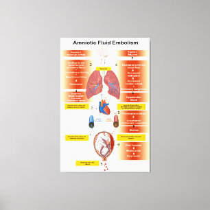 Lienzo Diagrama de un Embolismo Fluido Amniótico AFE