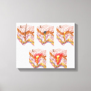 Lienzo Diversos tipos de acné