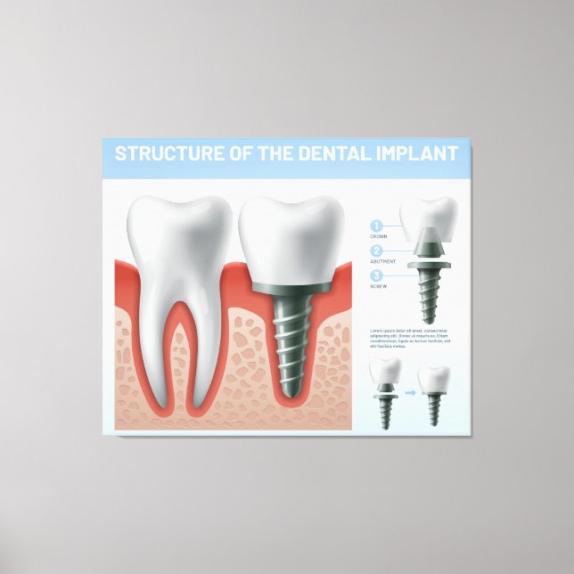 Lienzo Estructura del implante dental (Anverso)