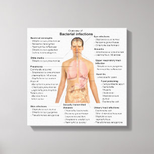 Lienzo Gráfico de infecciones bacterianas en humanos 