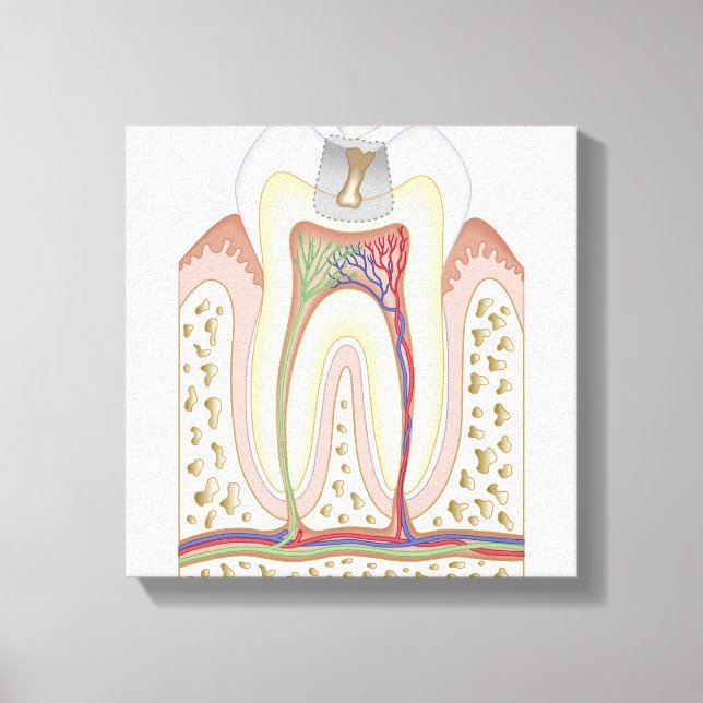 Lienzo Ilustracion de la caries dental (Anverso)