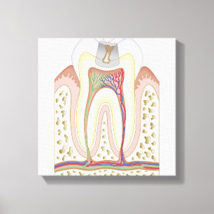 Lienzo Ilustracion de la caries dental