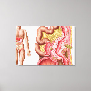 Lienzo Ilustracion de la diverticulosis en los dos puntos