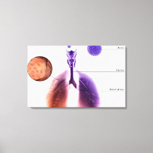 Lienzo Ilustracion de un ataque de asma del polen