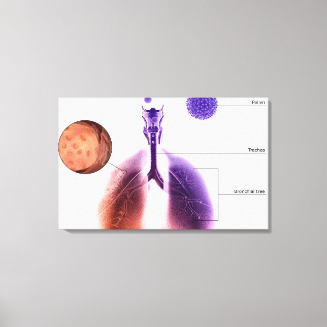 Lienzo Ilustracion de un ataque de asma por polen (Anverso)