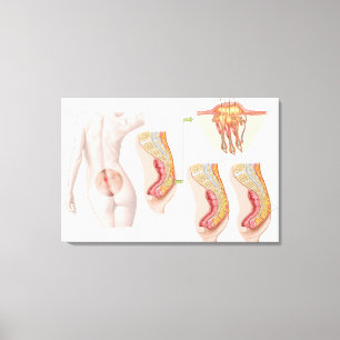 Lienzo Ilustración Médica De Un Ciclo Pilonidal