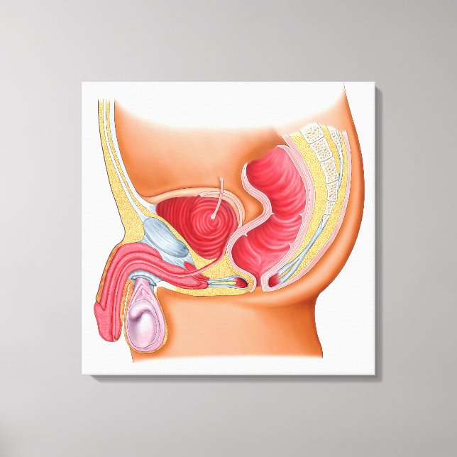Lienzo Ilustracion Médico De Una Fistula Rectouretral (Anverso)