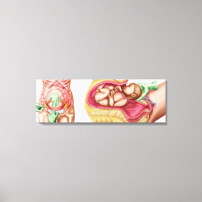 Lienzo Ilustracion Que Muestra La Entrega Cesareana Del F (Anverso)