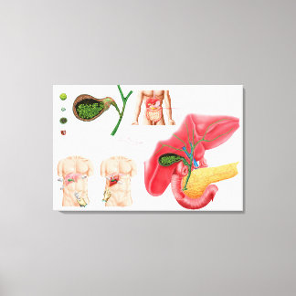 Lienzo Ilustracion que representa la colecistectomía